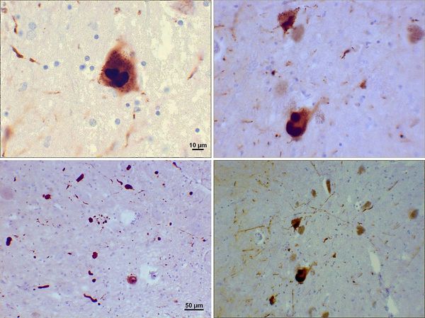 Magnification of alpha-synuclein intraneuronal inclusions, strand-like neurites & rounded Lewy bodies of various sizes